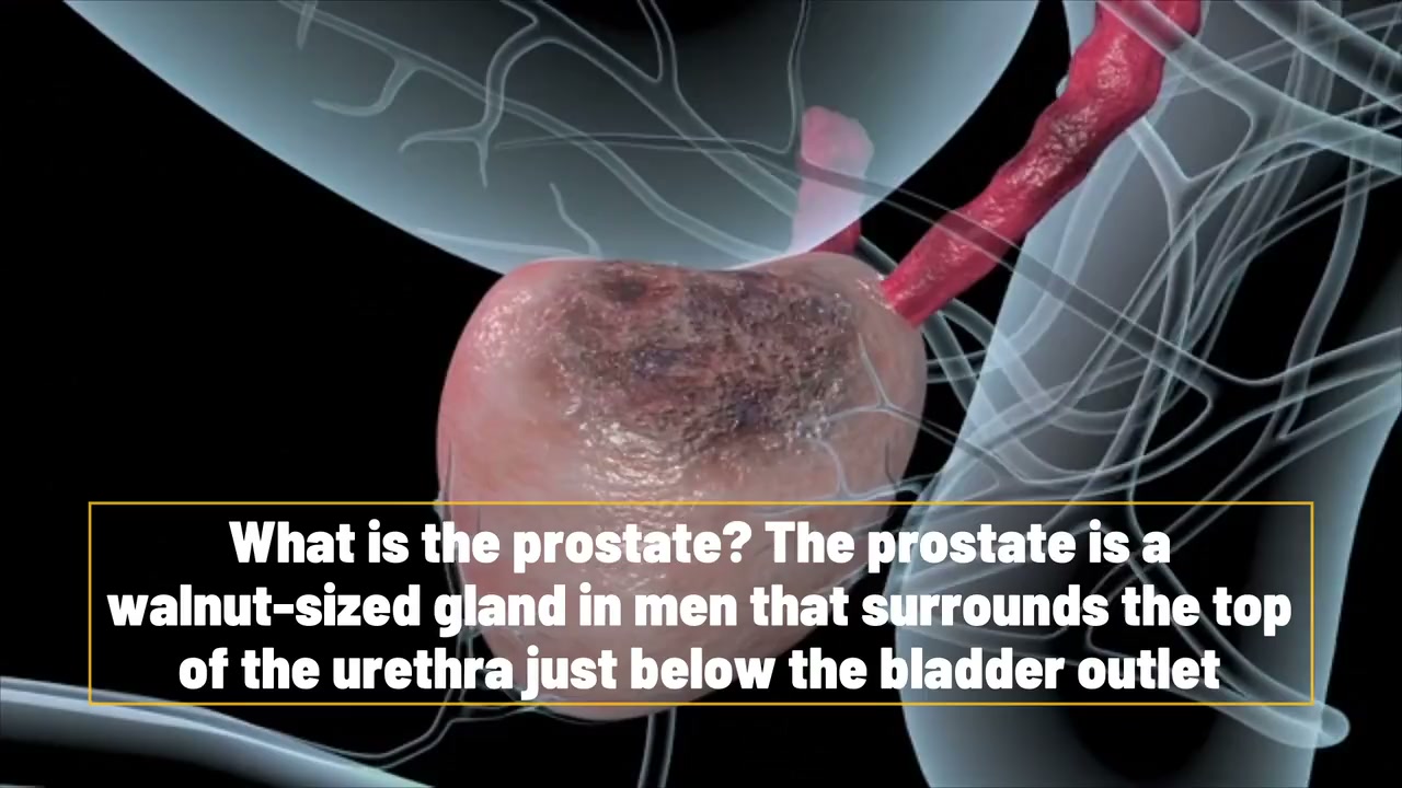 Prostate cancer: Nine things every man needs to know