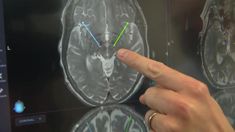Hartland musician uses deep brain stimulation to control Parkinson's