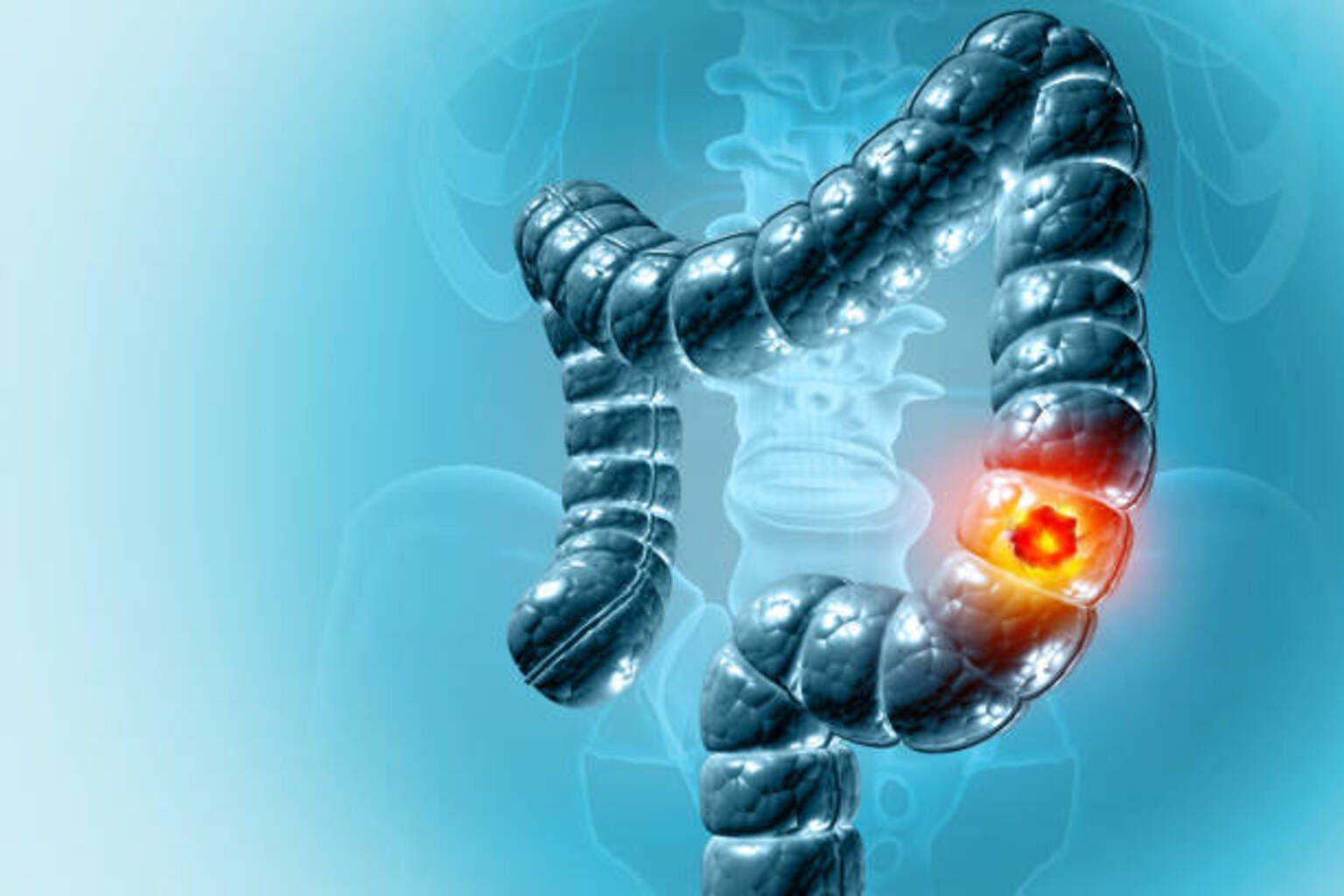 Genentech's Tecentriq gains new indication for colon cancer