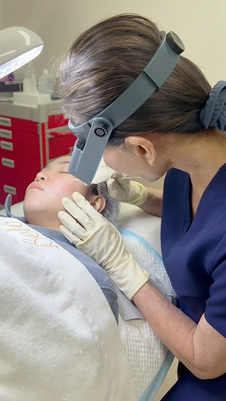 Ice pick acne scars are stubborn, but they’re not impossible to treat