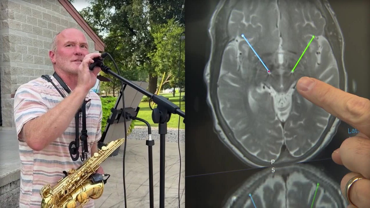 Hartland musician uses deep brain stimulation to control Parkinson's
