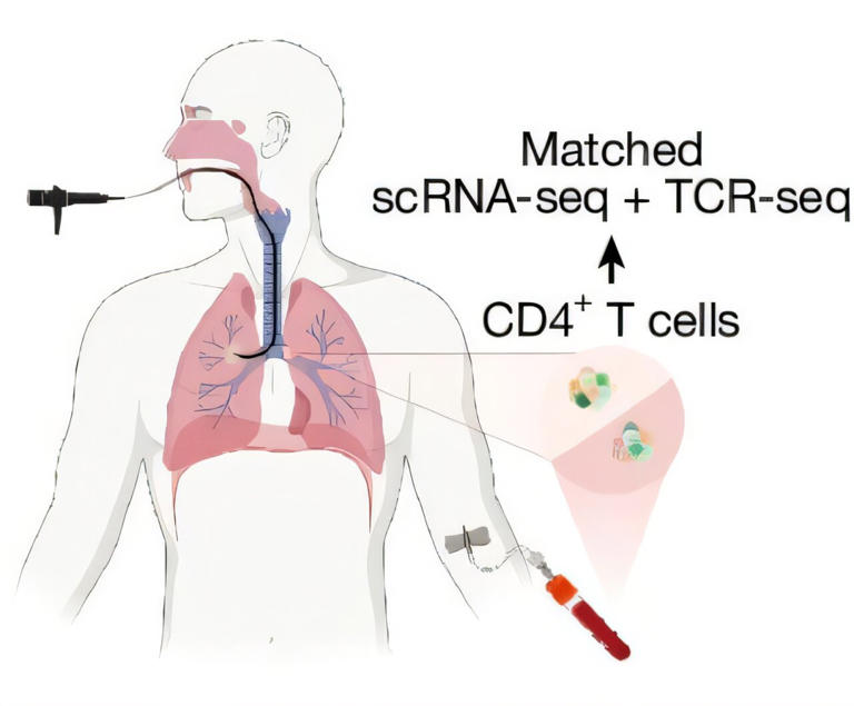 'Immune fog' may flag lung cancer risk years before tumor develops