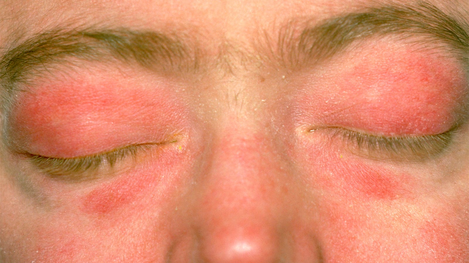 Treatment landscape for dermatomyositis is evolving