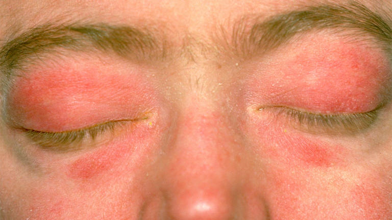 Treatment landscape for dermatomyositis is evolving