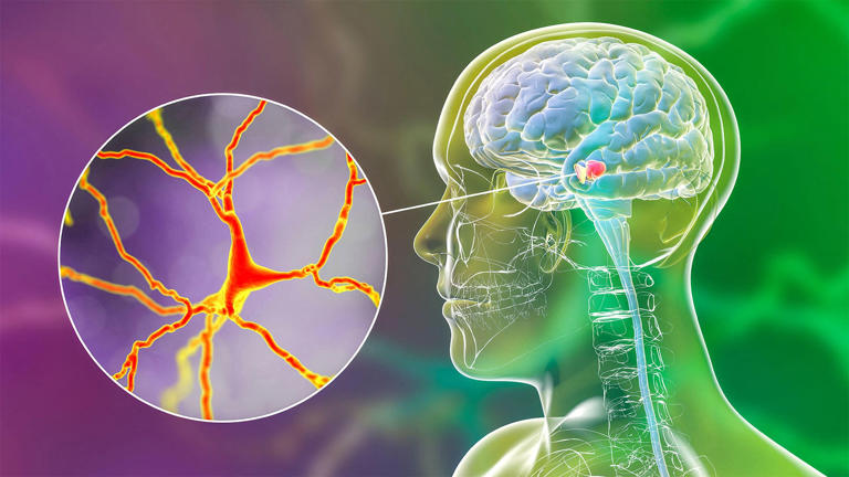 Popular longevity supplement fails to meet endpoint in Parkinson's trial