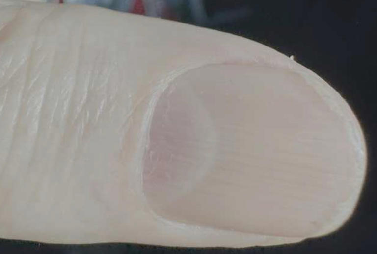 A subtle symptom in your fingernail could be a sign of congestive heart ...