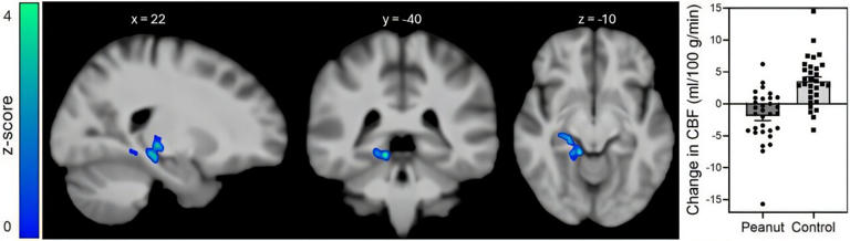Daily peanut consumption beneficially affects brain insulin ...