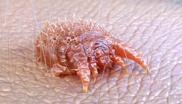 Itchy parasitic mites that lay eggs under your skin are infesting the UK