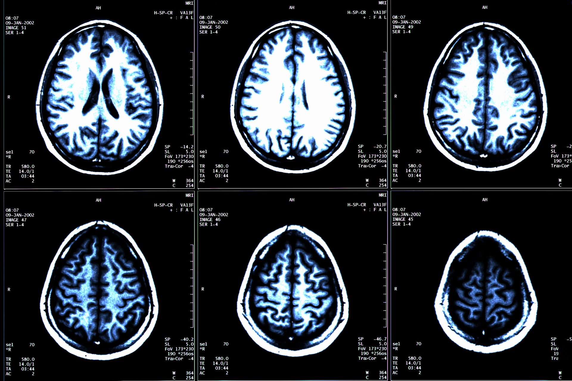Kissing disease could be cause of multiple sclerosis, research reveals