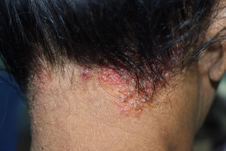 Itchy parasitic mites that lay eggs under your skin are infesting the UK