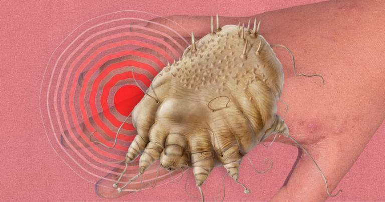 Itchy parasitic mites that lay eggs under your skin are infesting the UK