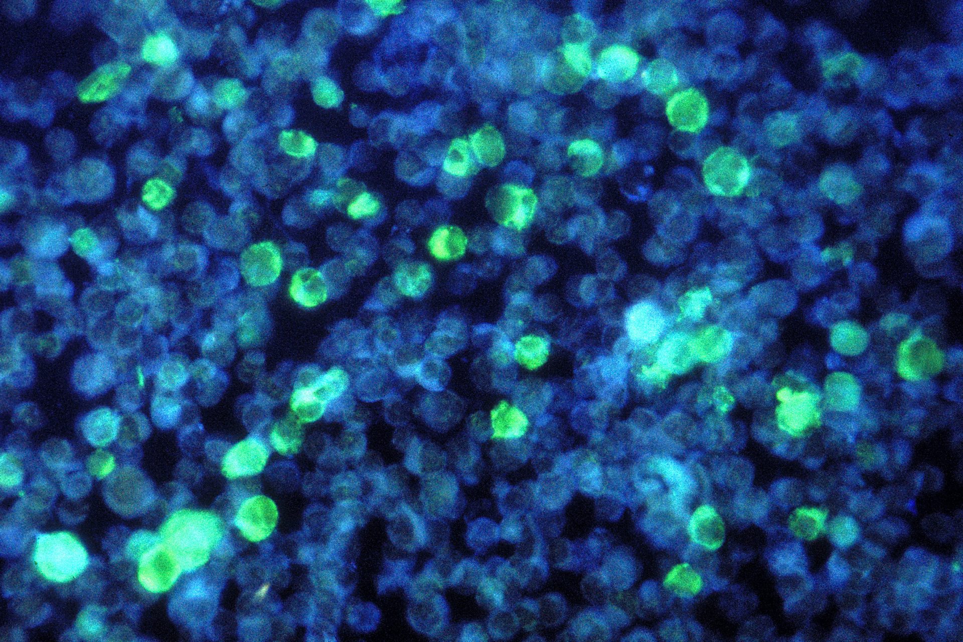 Kissing disease could be cause of multiple sclerosis, research reveals