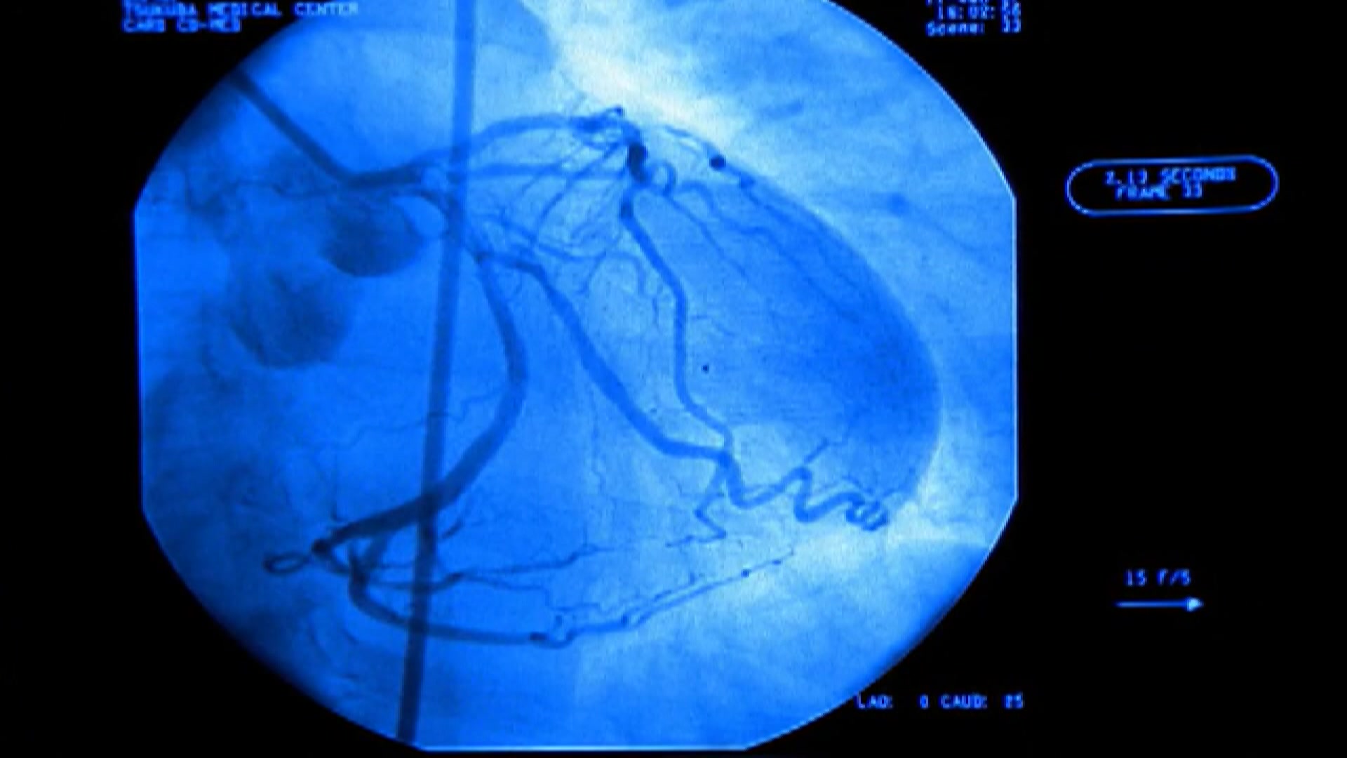 Doctors say genetics and background can impact heart disease risk