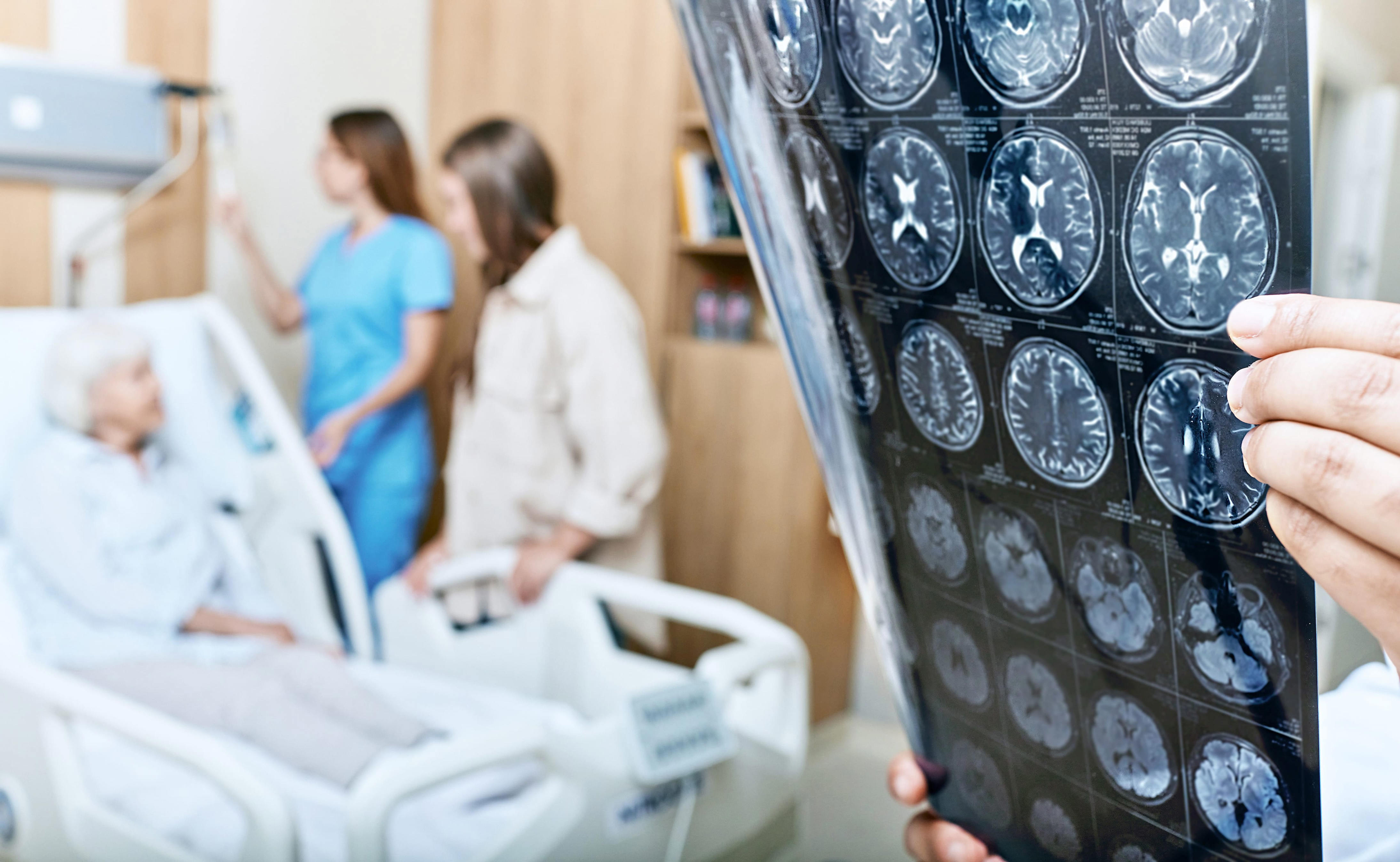 Maladie d'Alzheimer : la glucosamine pourrait augmenter sa progression