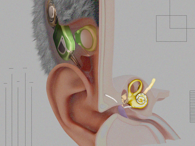 World’s first fully implanted cochlear implant reaches patients