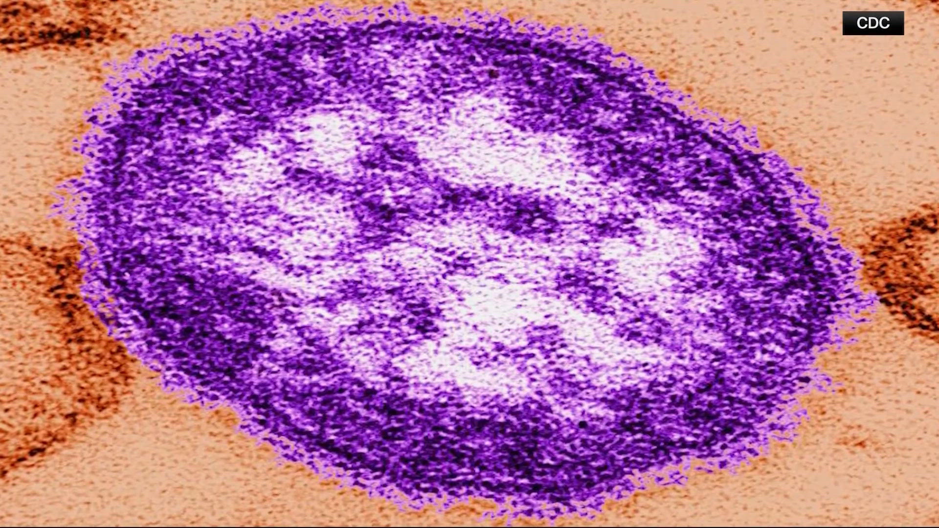 CDC reports 2 measles deaths nationwide