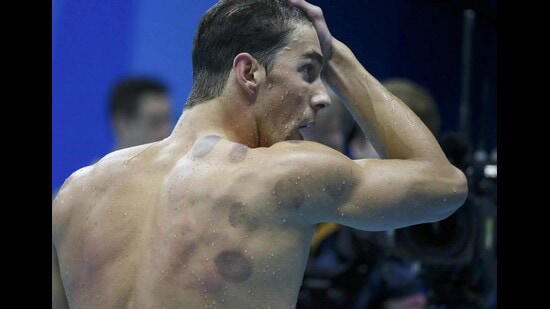 Cupping, ice baths and sleep: A deep dive into the science of recovery