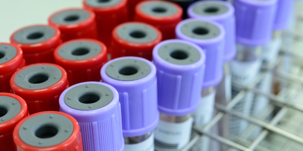 A blood test can now detect early Alzheimer’s changes in adults as ...