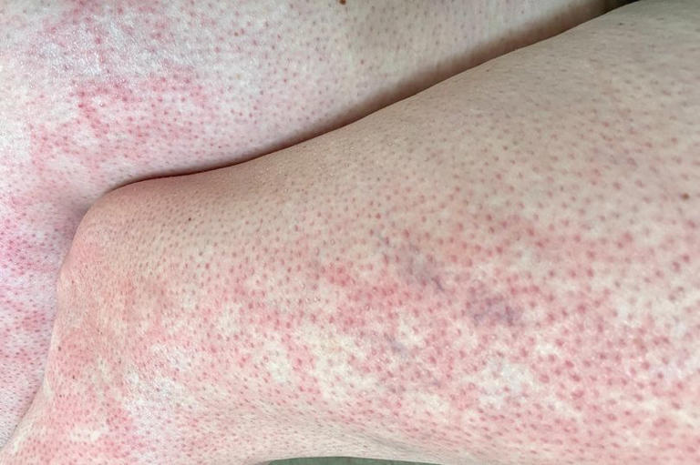 Hot water bottle and heater warning as thousands get 'toasted' rash