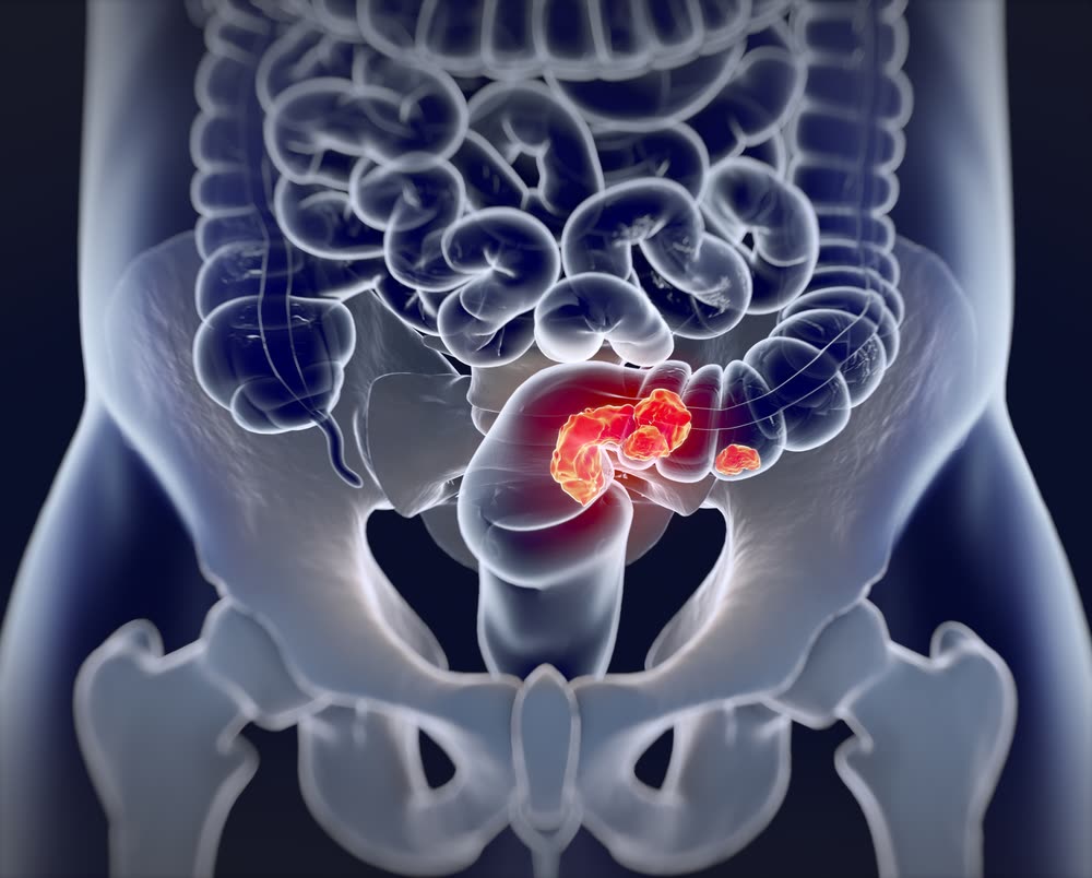 8 warning signs of colorectal cancer most people mistake for stomach ...