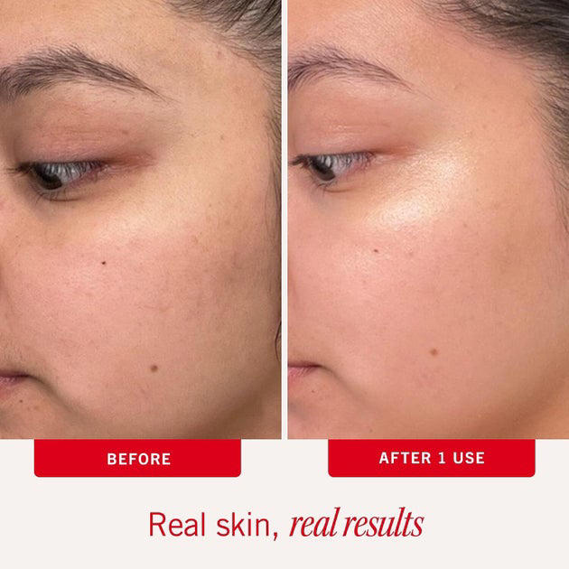 People who ‘had milia under my eyes for years’ say the bumps are now ...