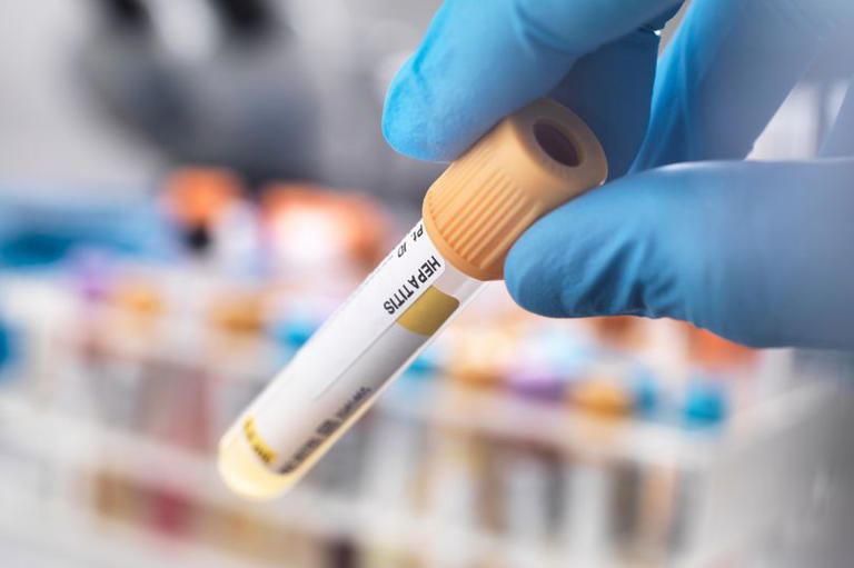 Hepatitis A cases confirmed at UK primary schools as warnings issued to ...