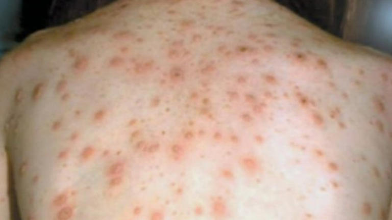 Measles warning for Sydney after infected patient visits numerous spots ...