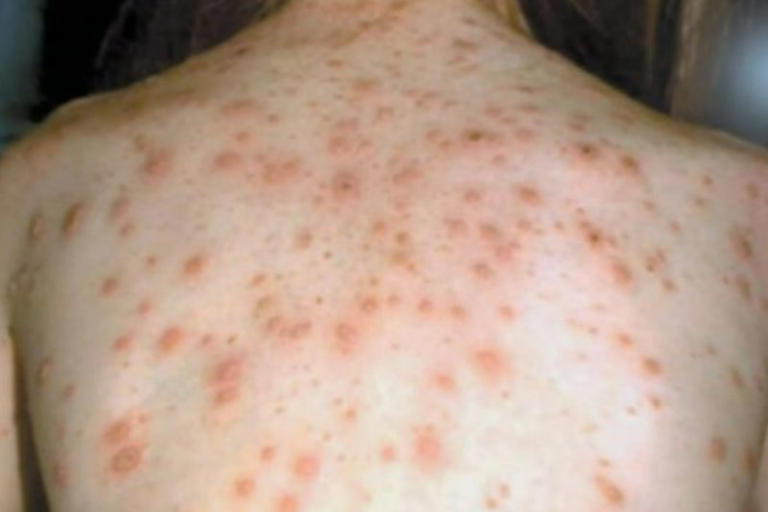 Measles warning for Sydney after infected patient visits numerous spots ...