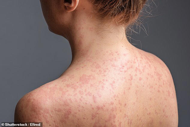 Urgent measles warning for Sydney after infected patient visits popular ...