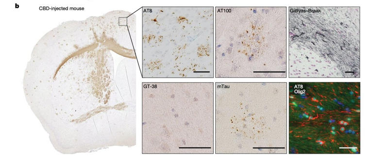 Human tau seeds trigger disease-specific shapes in mouse brains, new ...