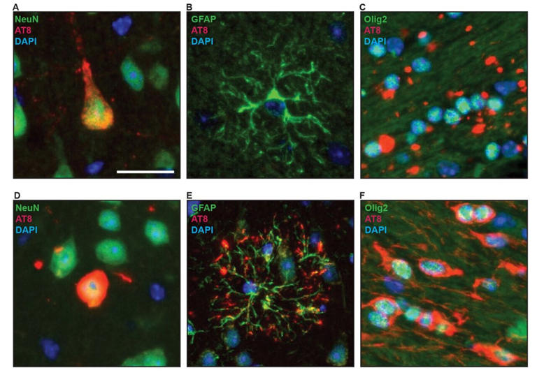 Human tau seeds trigger disease-specific shapes in mouse brains, new ...