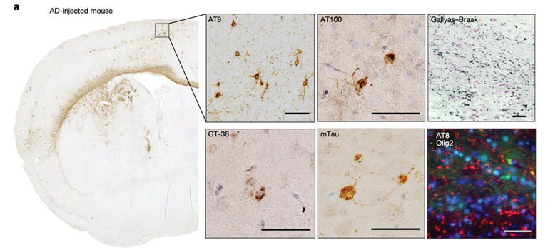 Human tau seeds trigger disease-specific shapes in mouse brains, new ...