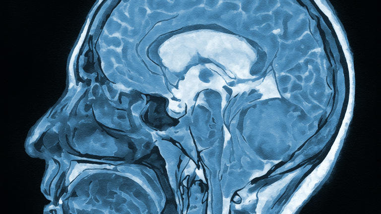 Brain scans of 24 people with long COVID reveal signs of injury to ...