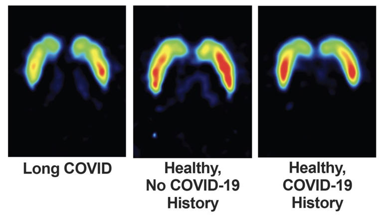 Brain scans of 24 people with long COVID reveal signs of injury to ...