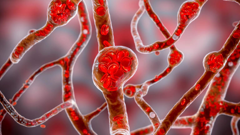Scientists might have found a new cause of high blood pressure, and a ...