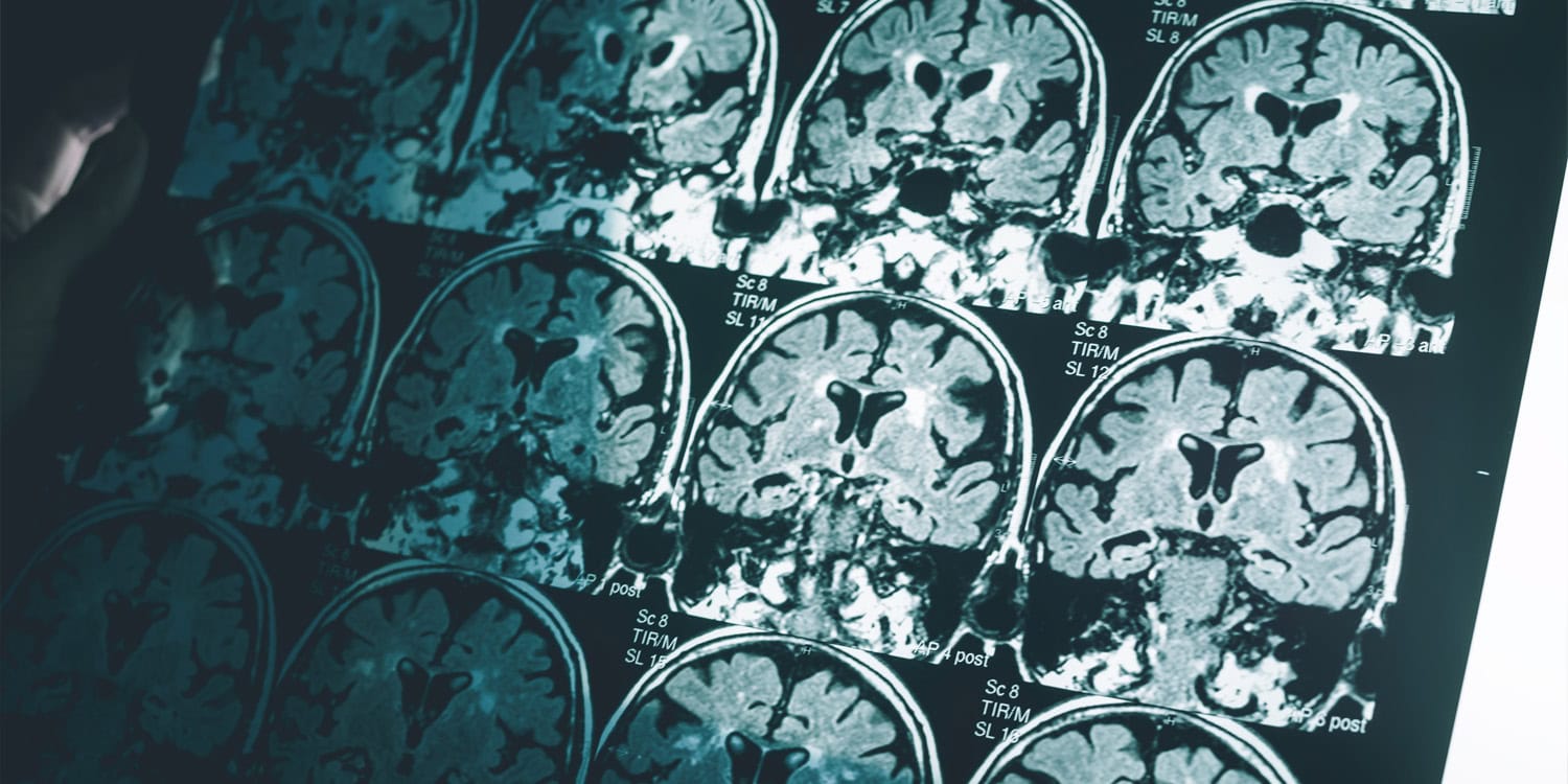 Early neglect may disrupt how the brain fine-tunes itself during ...