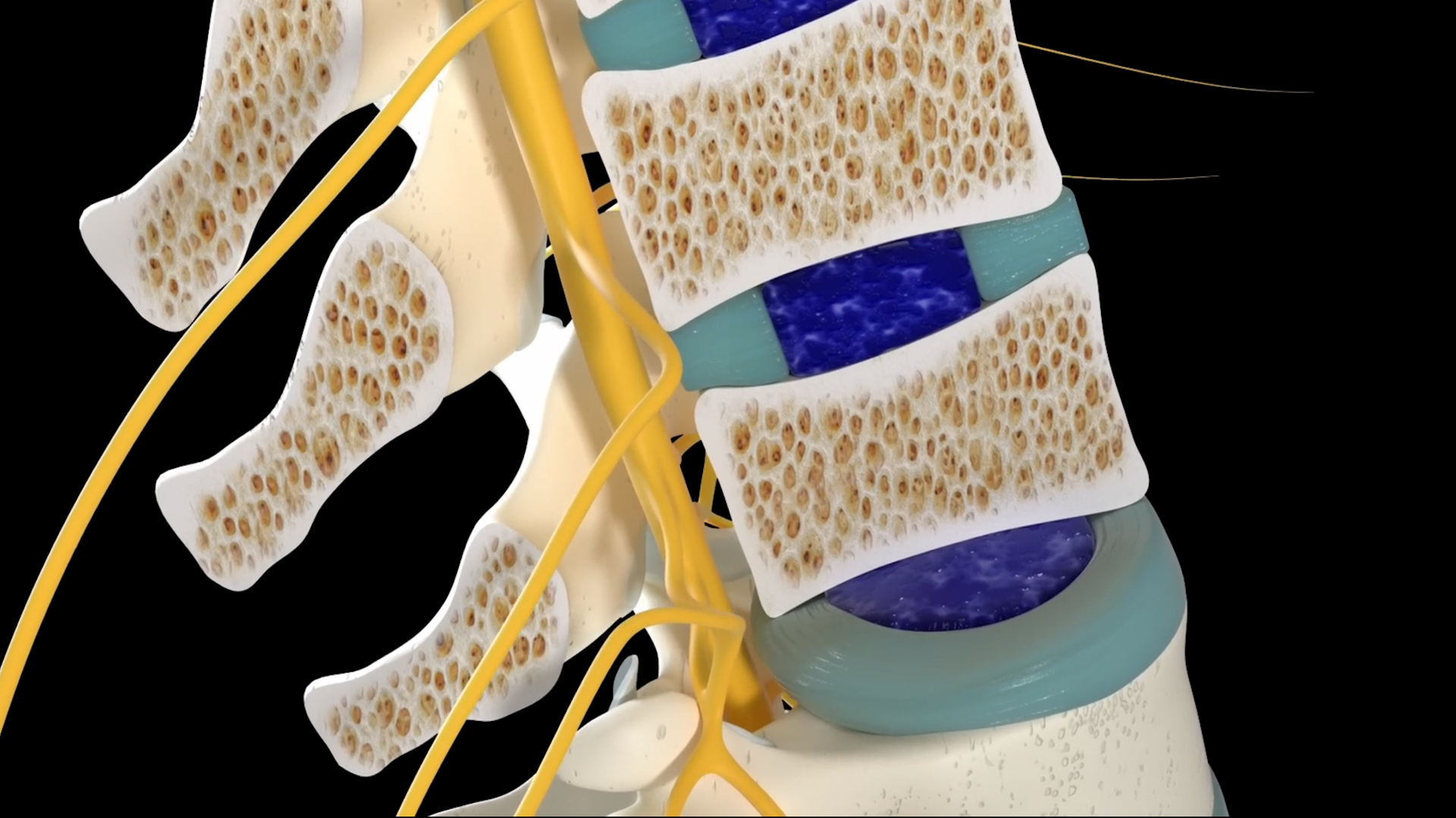 Why spinal stenosis makes walking so hard, explained by a spine surgeon