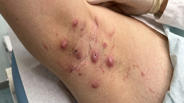 Perché l'uso di GLP-1 agonisti contro l'acne inversa riduce anche la ...