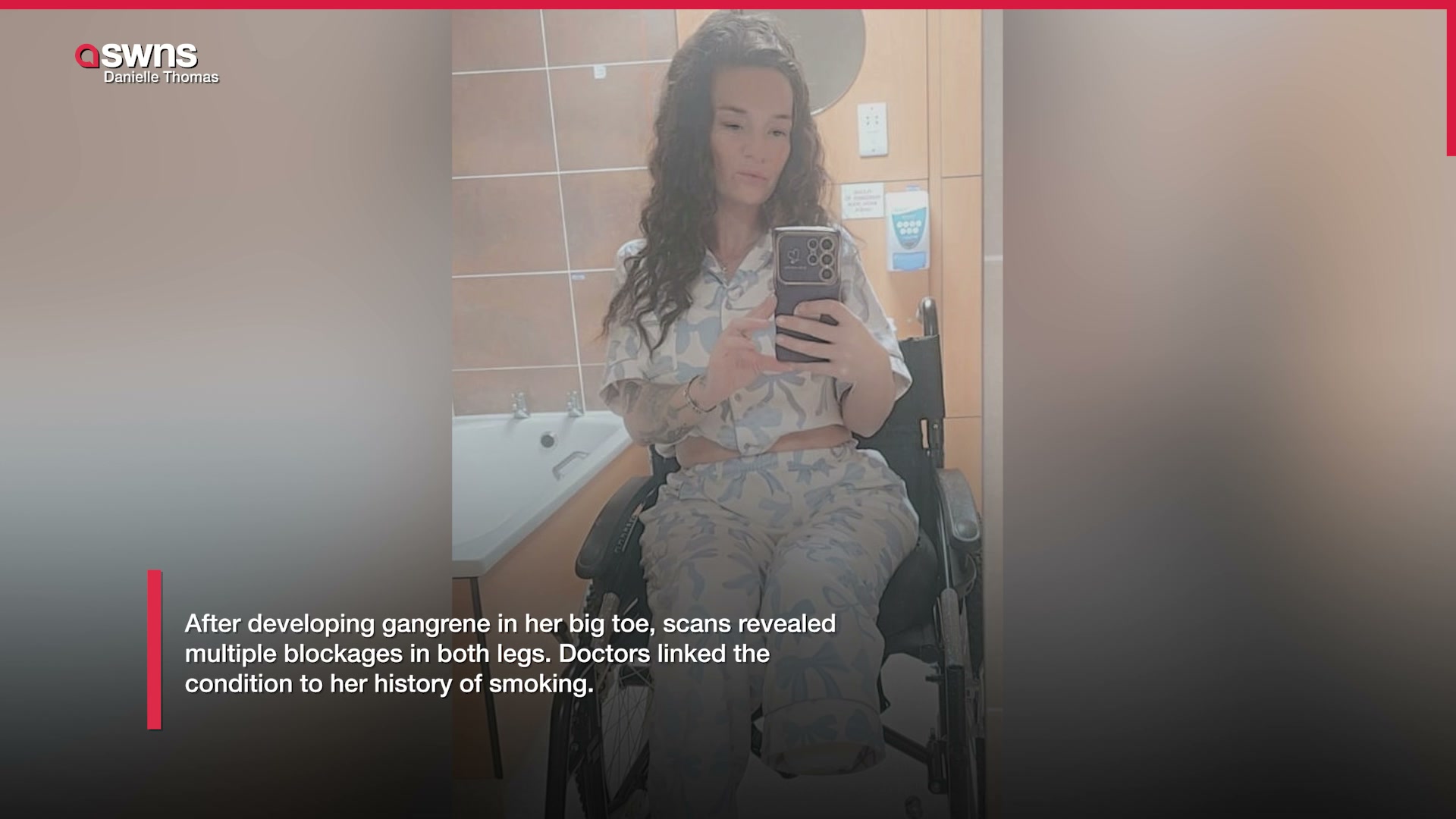 Mum has leg amputated after rare vascular disease was allegedly ...