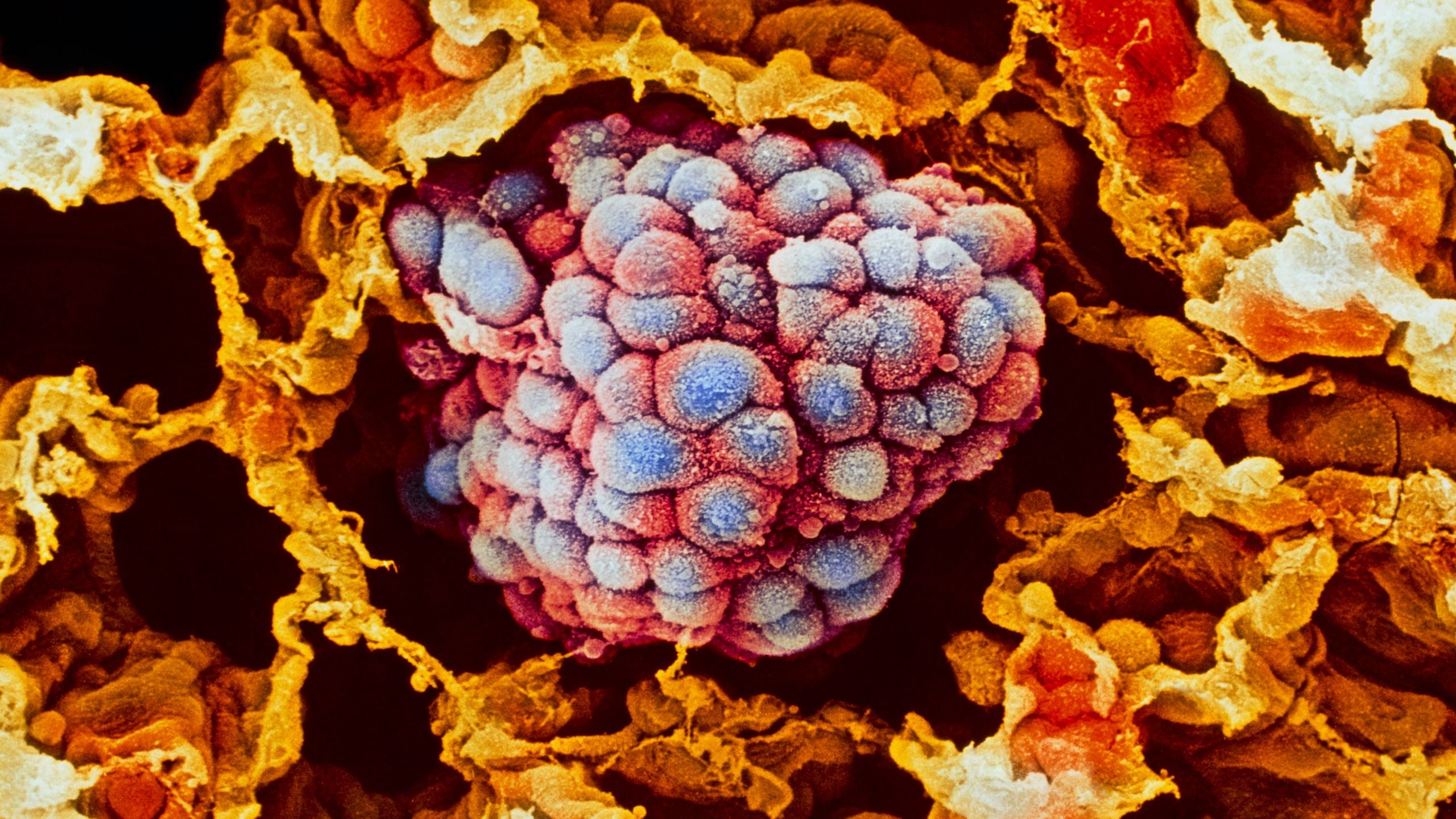 A cheap deworming pill could help beat drug-resistant lung cancer