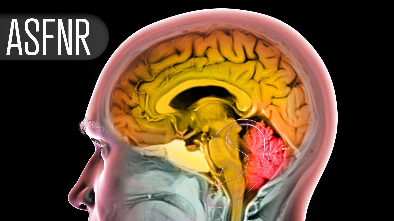 Microvascular measure gives clues to poor response to successful ...
