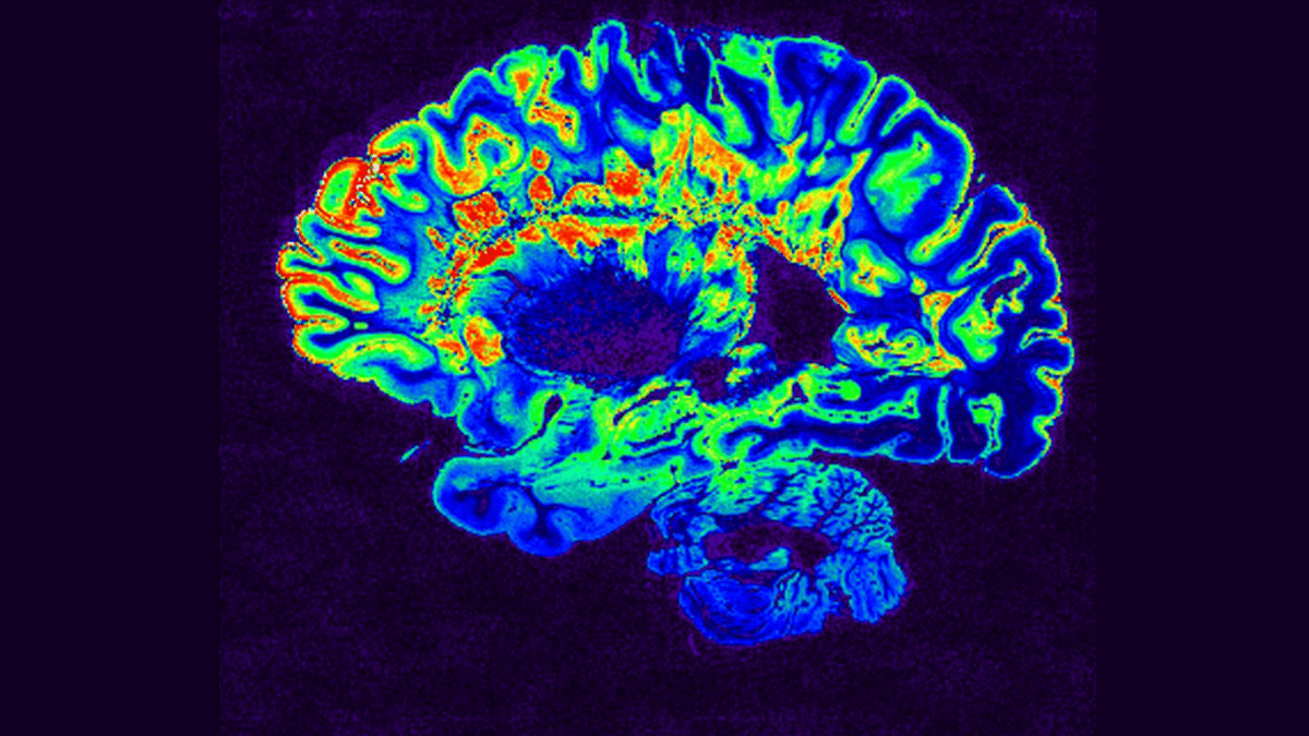 Does air pollution cause dementia? What new studies say on what it does ...