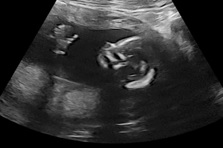 Redcar mum's heartbreak at loss of baby girl after heart-rate ...