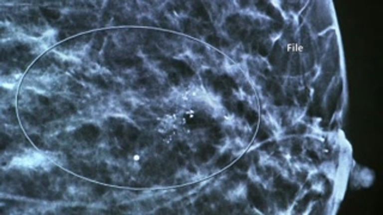 Belmont County health officials urge breast cancer checks and age-based ...