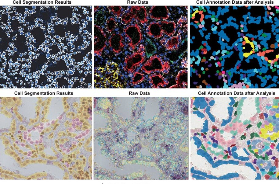 Kidney biopsy maps reveal immune clusters that may keep inflammation going