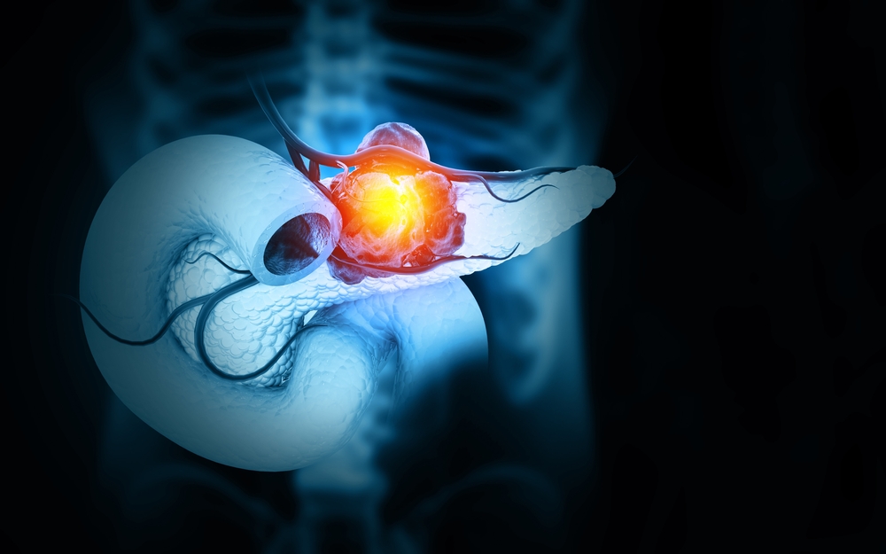 A Mayo Clinic AI may predict your pancreatic cancer risk up to 5 years ...