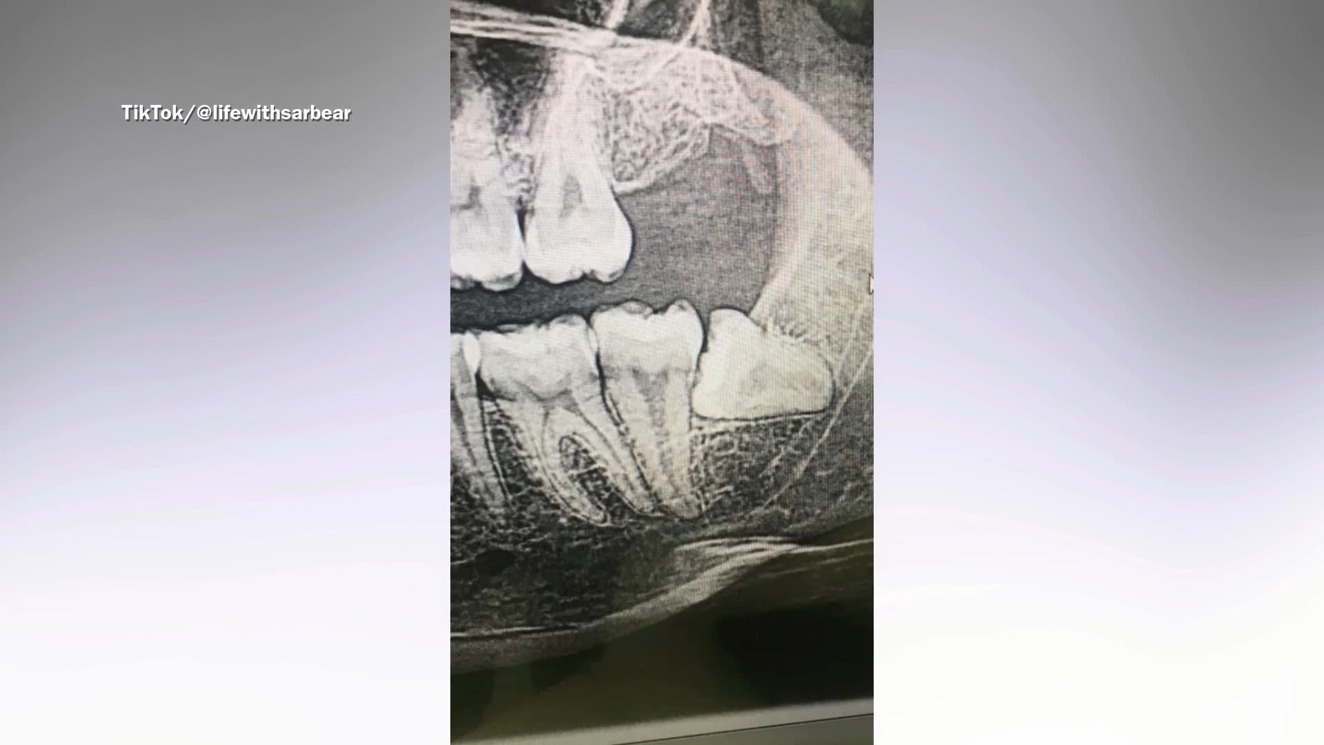 Woman had wisdom tooth removed—hours later she was in critical condition