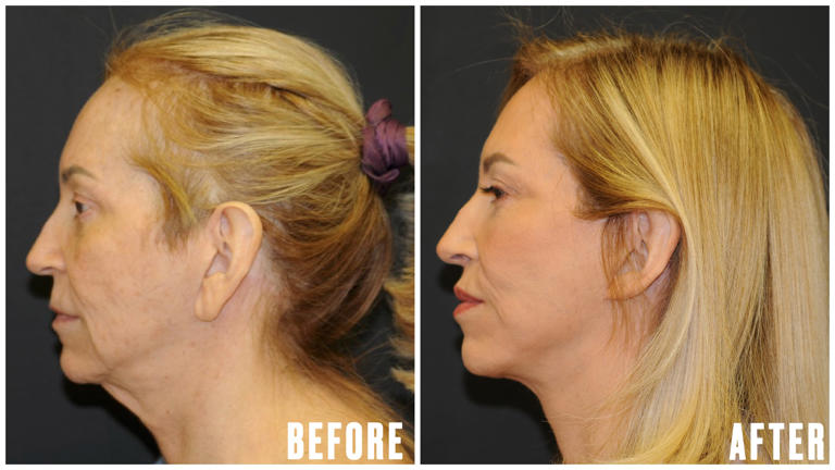 Woman gets life-changing surgery for common GLP-1 side effect