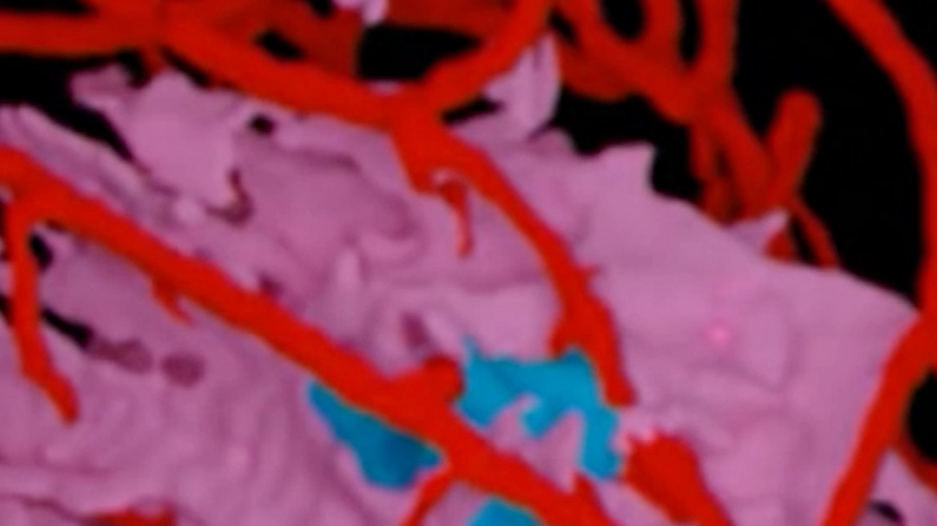 FDA clears new AI tool that can estimate risk of breast cancer recurrence