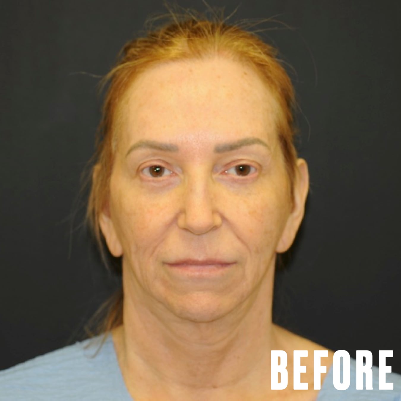 Woman gets life-changing surgery for common GLP-1 side effect